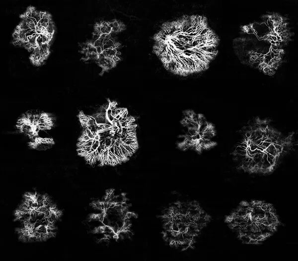 Detection of MNV on OCTA using Toward Pi