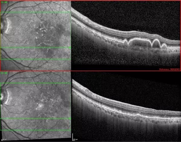 la photobiomodulation.