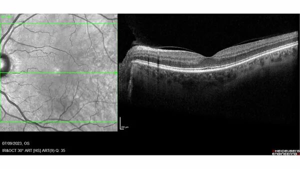 Traction vitréo-maculaire
