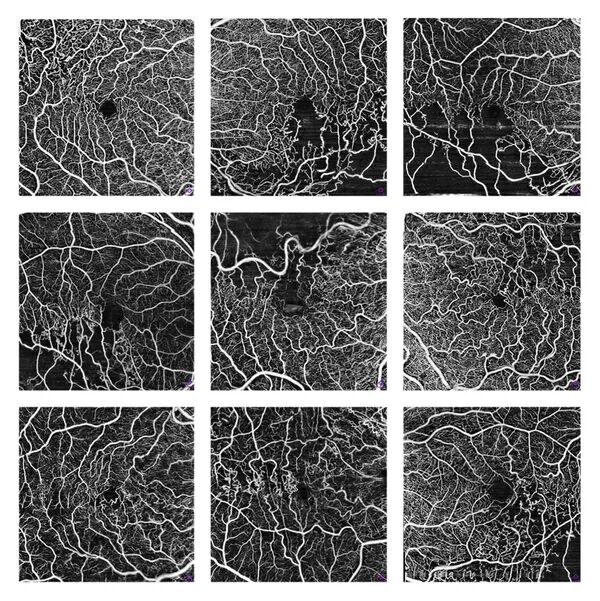 Branch Vein Occlusion 
